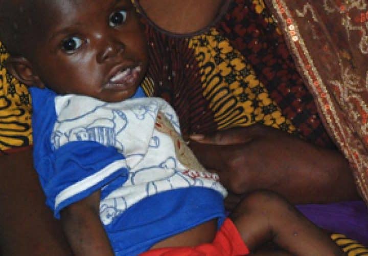 Enfant souffrant de malnutrition au Mali Enfant souffrant de malnutrition au Mali